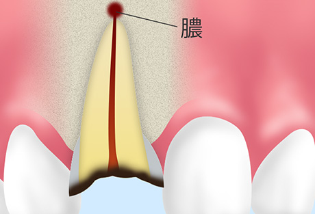 通常の根管治療で完治しない場合の処置　「歯根端切除術」について